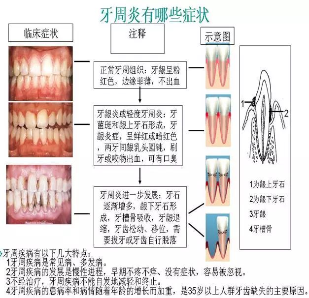 智能口腔护理设备在牙周病预防中的实用价值探讨